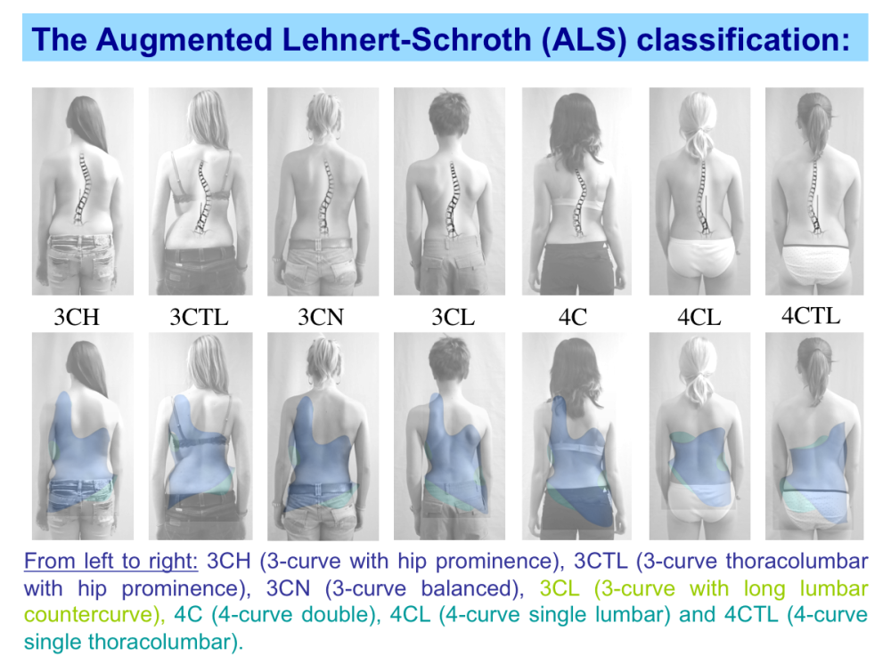 Scoliosis SBPRS | The original classification according to Lehnert-Schroth